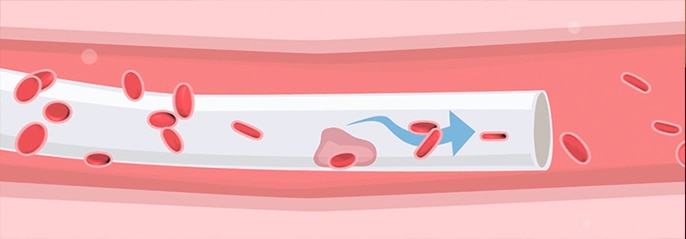 Medical illustration of an occluded catheter in a blood vessel