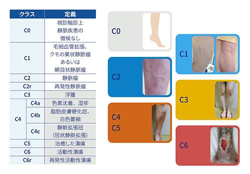Venous Technology - 下肢深部静脈の治療 | BD