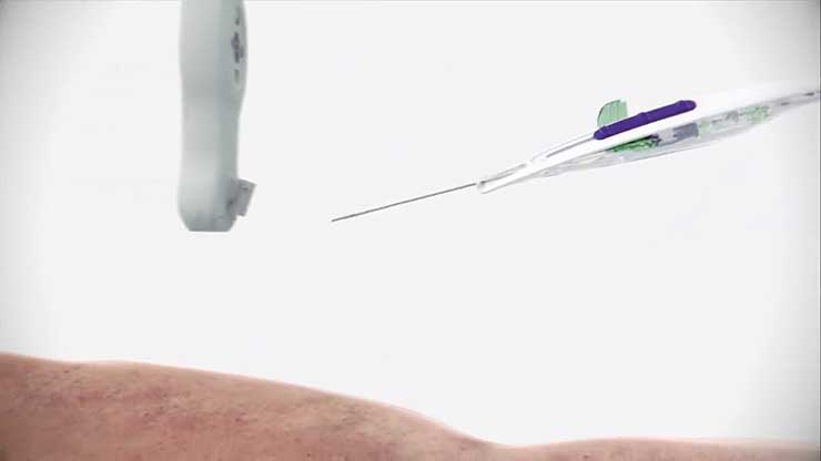 PowerGlide Pro middline catheter insertion video