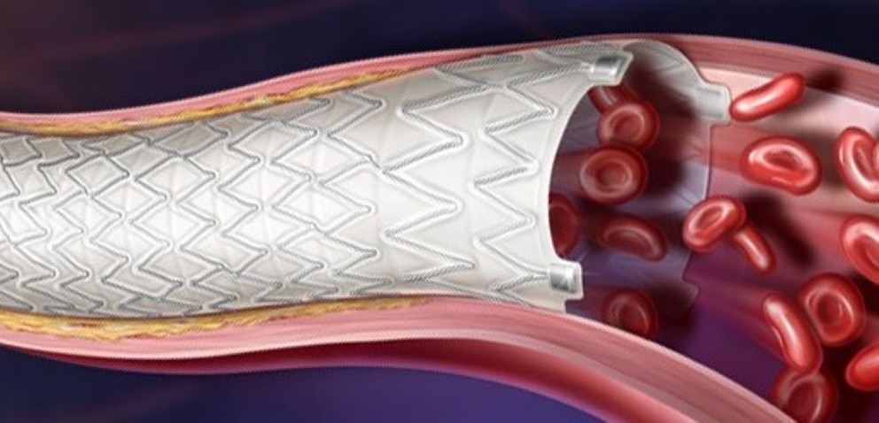 Vascular Covered Stent 