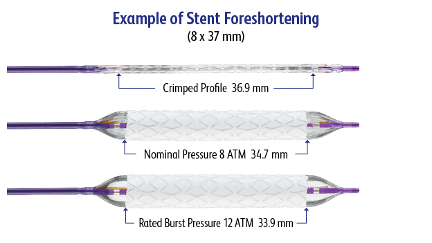 <p><sup>The radiopaque marker bands of the LifeStream™ Covered Stent have been specifically positioned on the balloon catheter at the ends of the crimped covered stent to facilitate accurate stent placement. And when millimeters count, the LifeStream™ Covered Stent, with an average of 3.5% foreshortening across all balloon sizes at nominal inflation pressure<sup>2</sup>, achieved a high Acute Technical Success Rate of 98.3% in the BOLSTER Study<sup>3</sup>. </sup></p>
<h2>Minimal Foreshortening</h2>
<p>The LifeStream™ Balloon Expandable Vascular Covered Stent is designed to maximize your lesion coverage with minimal foreshortening and facilitate accurate placement. </p>
