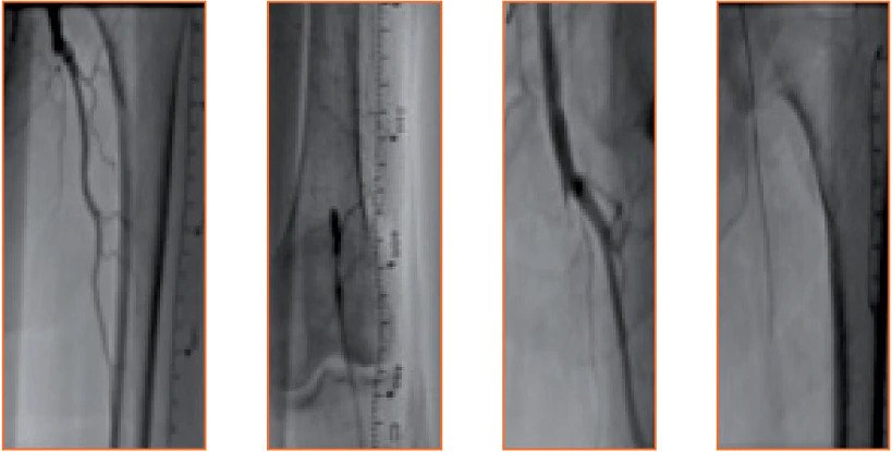 <h3>Before treatment, Flush occlusion of left SFA to PII segment. Crossed intraluminally with guidewire.</h3>
