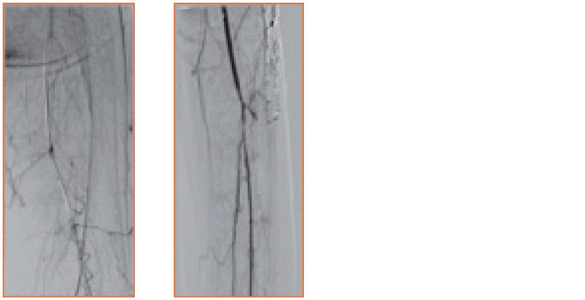 <h3>Extensive collaterals of SFA reconstituting at PII segment, with 2 vessel run-off BTK.</h3>
