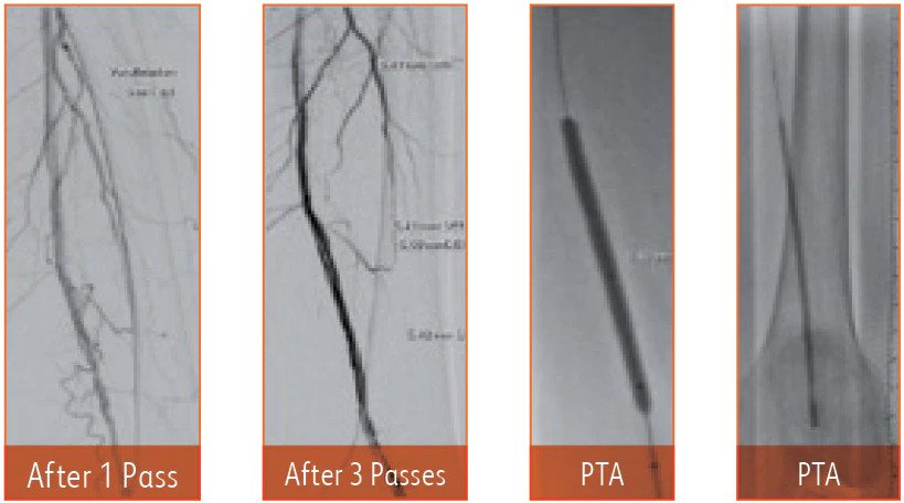 <h3>Angiogram after 1 and 3 passes with Rotarex™ Atherectomy Catheter.</h3>
