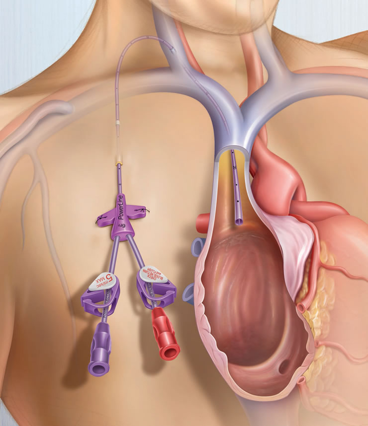 New Zealand Intermediate Socialisme PowerLine™ Central Venous Catheter