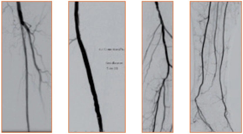 <h3>Final angiogram showing restored flow in SFA and 3 vessel run-off BTK.</h3>
