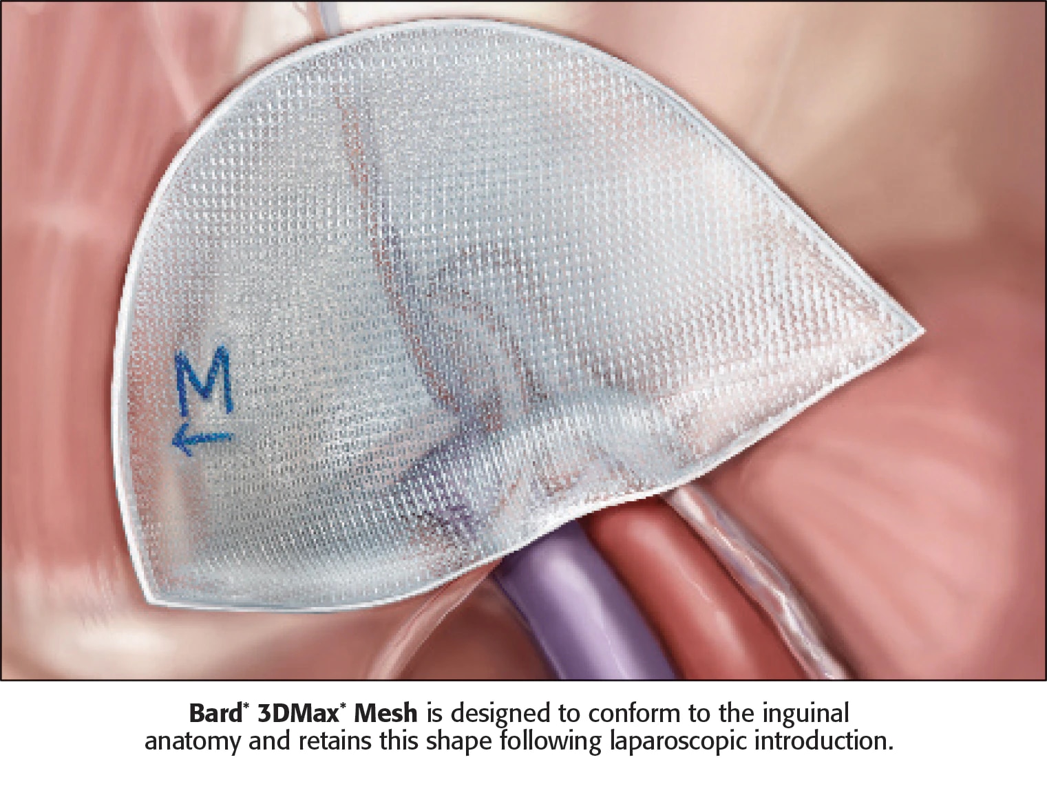 Types and Characteristics of the Mesh