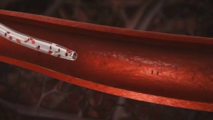 BD Nexiva Diffusics catheter diffusion animation | BD