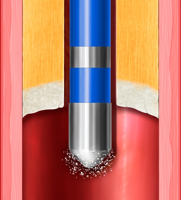 <p>キャビテーション</p>
