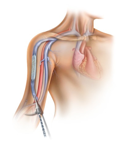 Lutonix Drug Coated Balloon Catheter AV