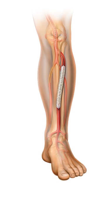 Lutonix Drug Coated Balloon Catheter BTK