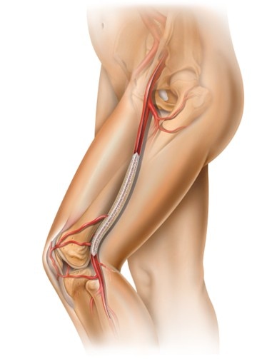 Lutonix Drug Coated Balloon Catheter SFA