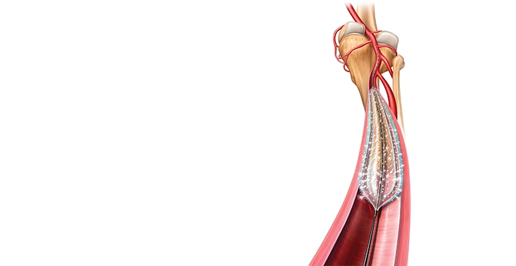 Lutonix™ 014 Drug Coated Balloon PTA Catheter 