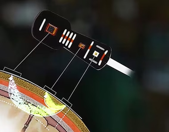 ForeSight penetration graphic