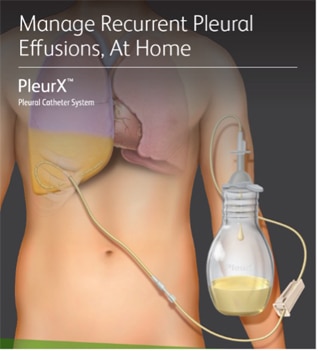 pleurx_catheter.jpg